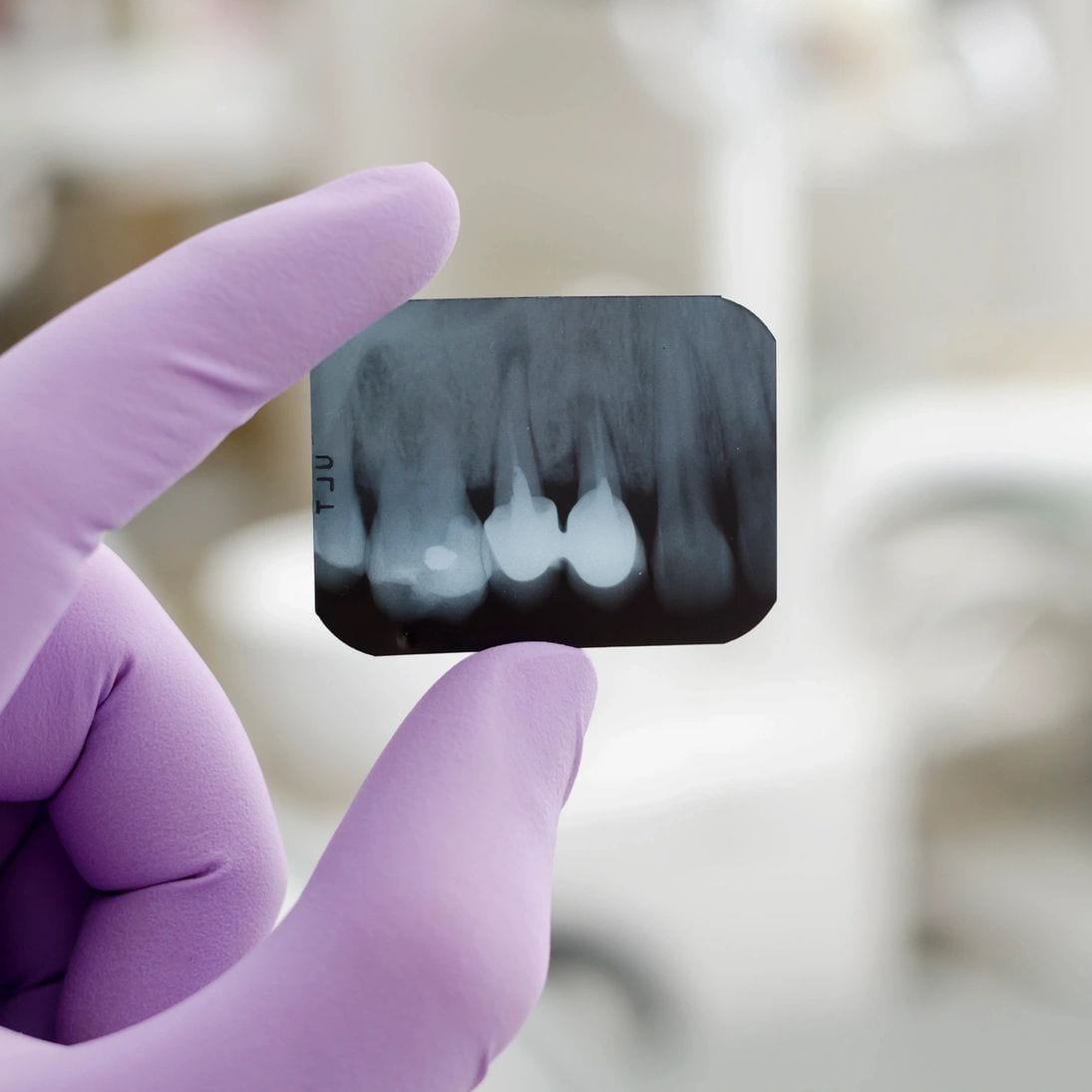 Bonding dental treatment at Waterford Dental Associates