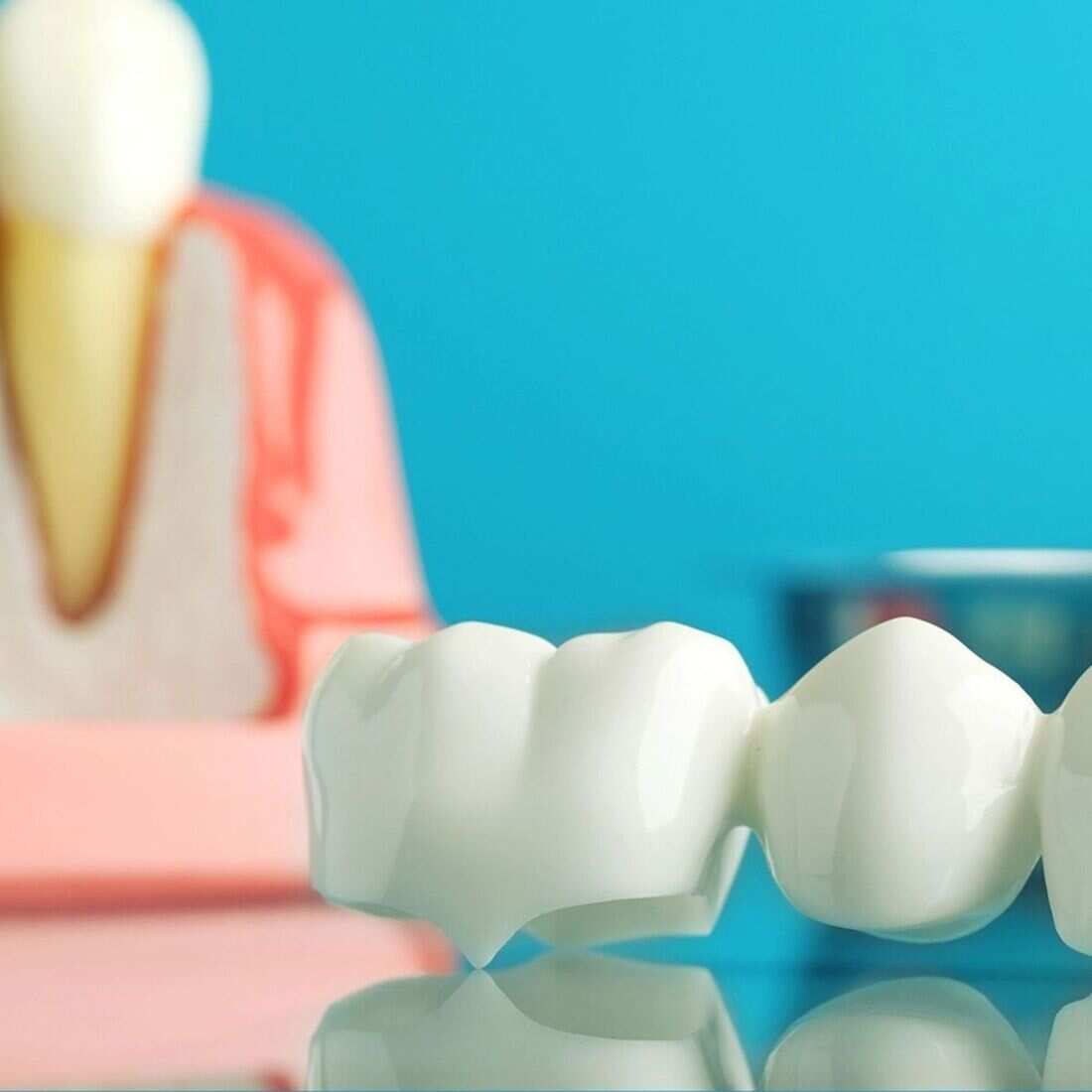 Bridges dental treatment at Waterford Dental Associates