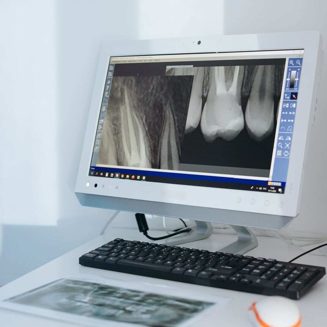 Endodontics (Root Canal) dental treatment at Waterford Dental Associates