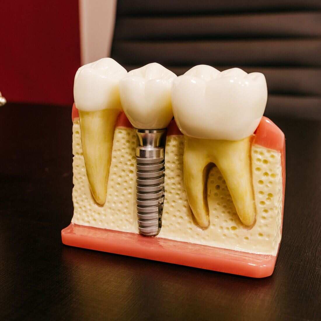 Implants dental treatment at Waterford Dental Associates